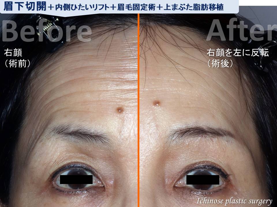 ビフォーアフター症例写真（拡大眉下切開 内側前額リフト 眉毛固定術 脂肪移植