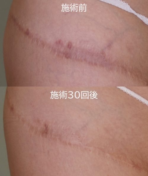 傷跡修正　Bi-one症例