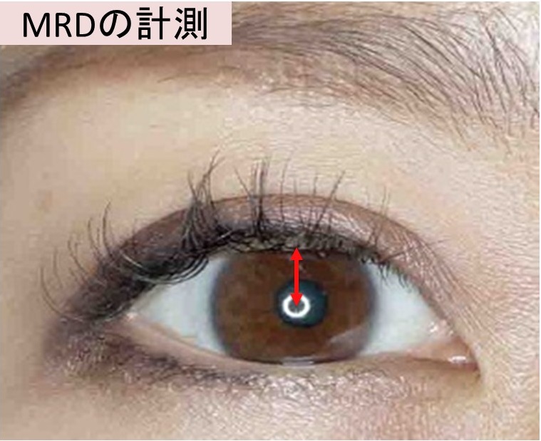 MRDの計測（眼瞼下垂の検査）