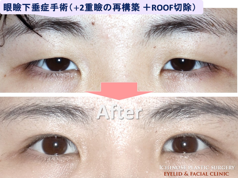 ,いちのせ式（４点留め）部分切開法眼瞼下垂症手術＋二重瞼再構築＋ROOF切除の症例写真