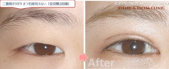 切開法で二重になりにくい瞼の修正    二重の乱れの修正