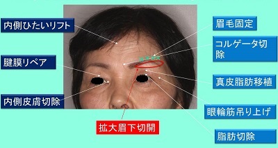 眉下切開＋眉下切除皮膚の脂肪移植＋内側前額ﾘﾌﾄ,症例写真,ビフォーアフター,術前術後