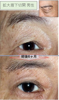 眉下切開＋眉下切除皮膚の脂肪移植＋内側前額ﾘﾌﾄ,症例写真,ビフォーアフター