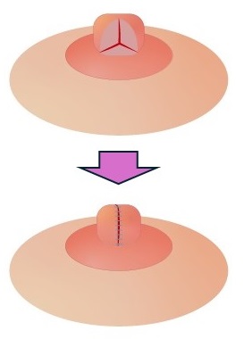 乳頭縮小術１