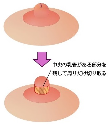 乳頭温存１