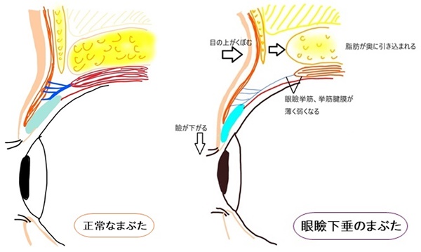 眼瞼下垂の症状をイラストでわかりやすく解説
