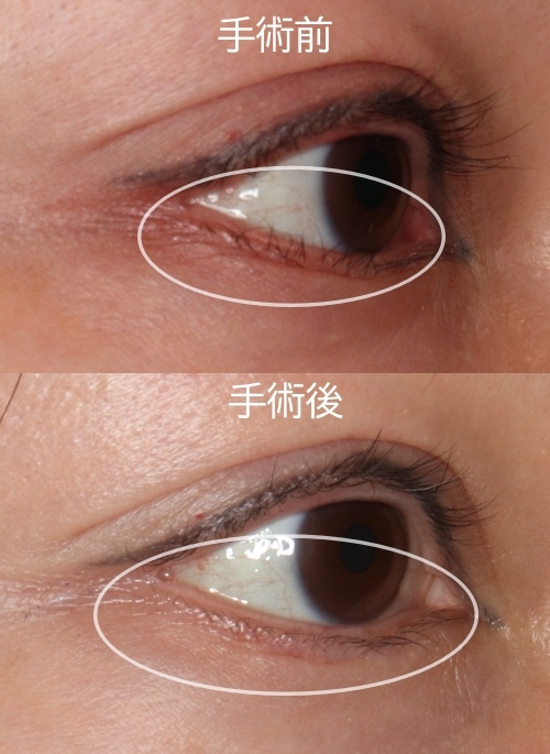 酒井Dr.下制筋手術症例写真1