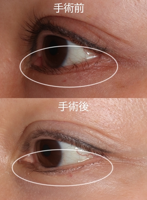 酒井Dr.下制筋手術症例写真2