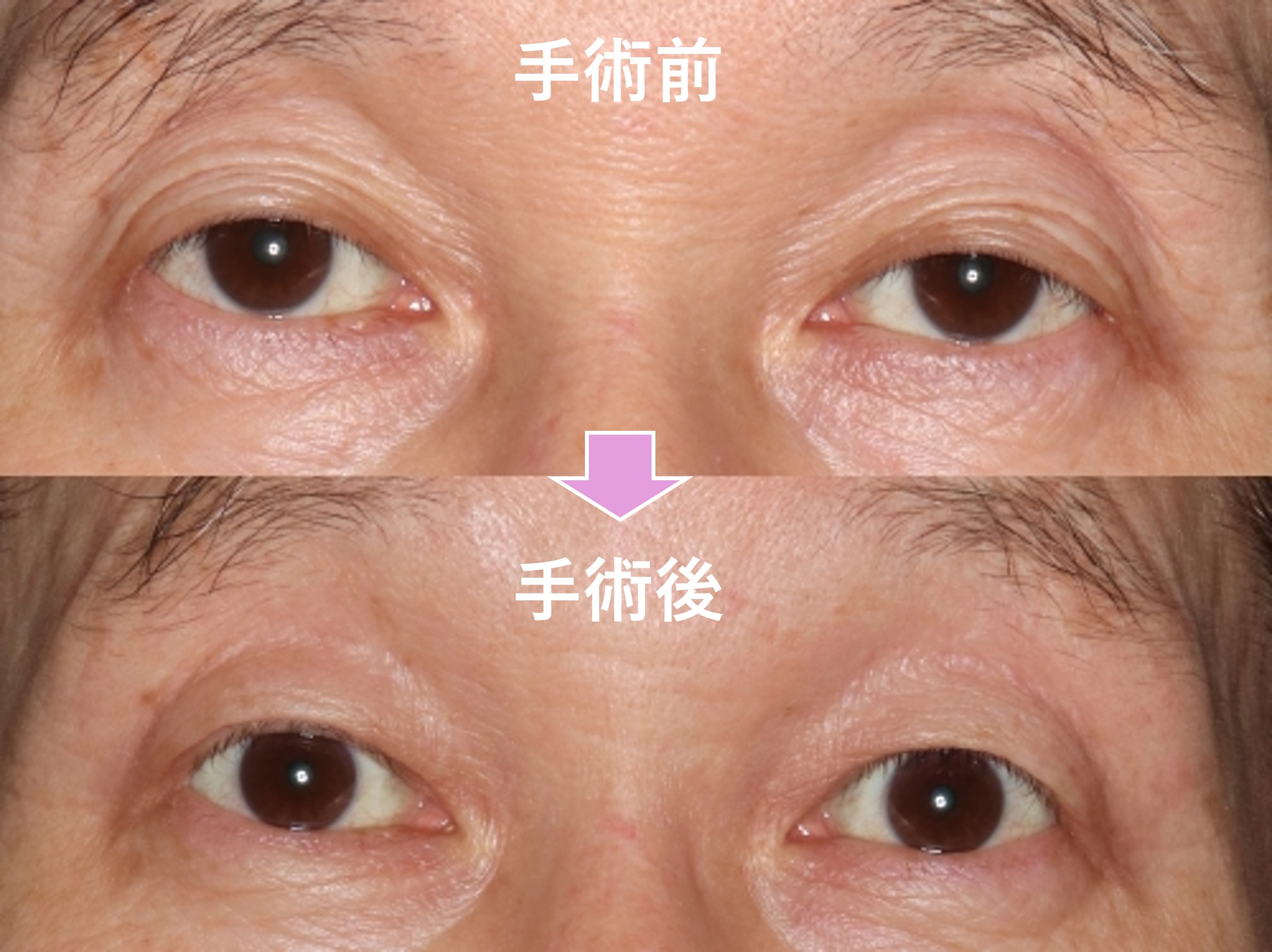 酒井Dr.中高年の内反症例写真