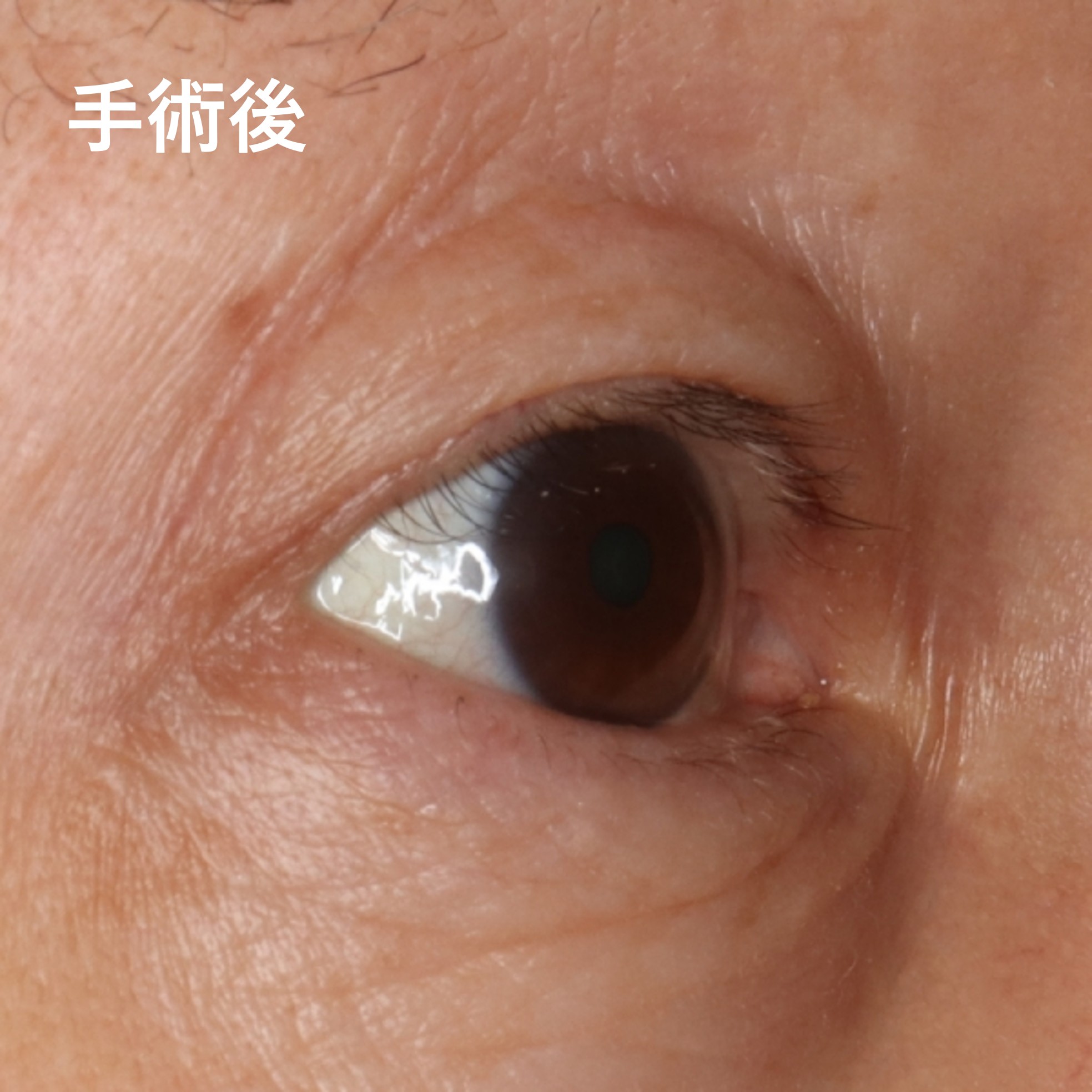 酒井Dr.中高年の内反症例写真