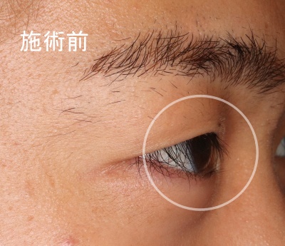 酒井Dr.先天性内反症症例写真1