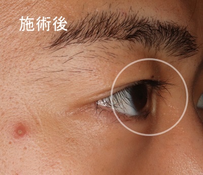 酒井Dr.先天性内反症症例写真1