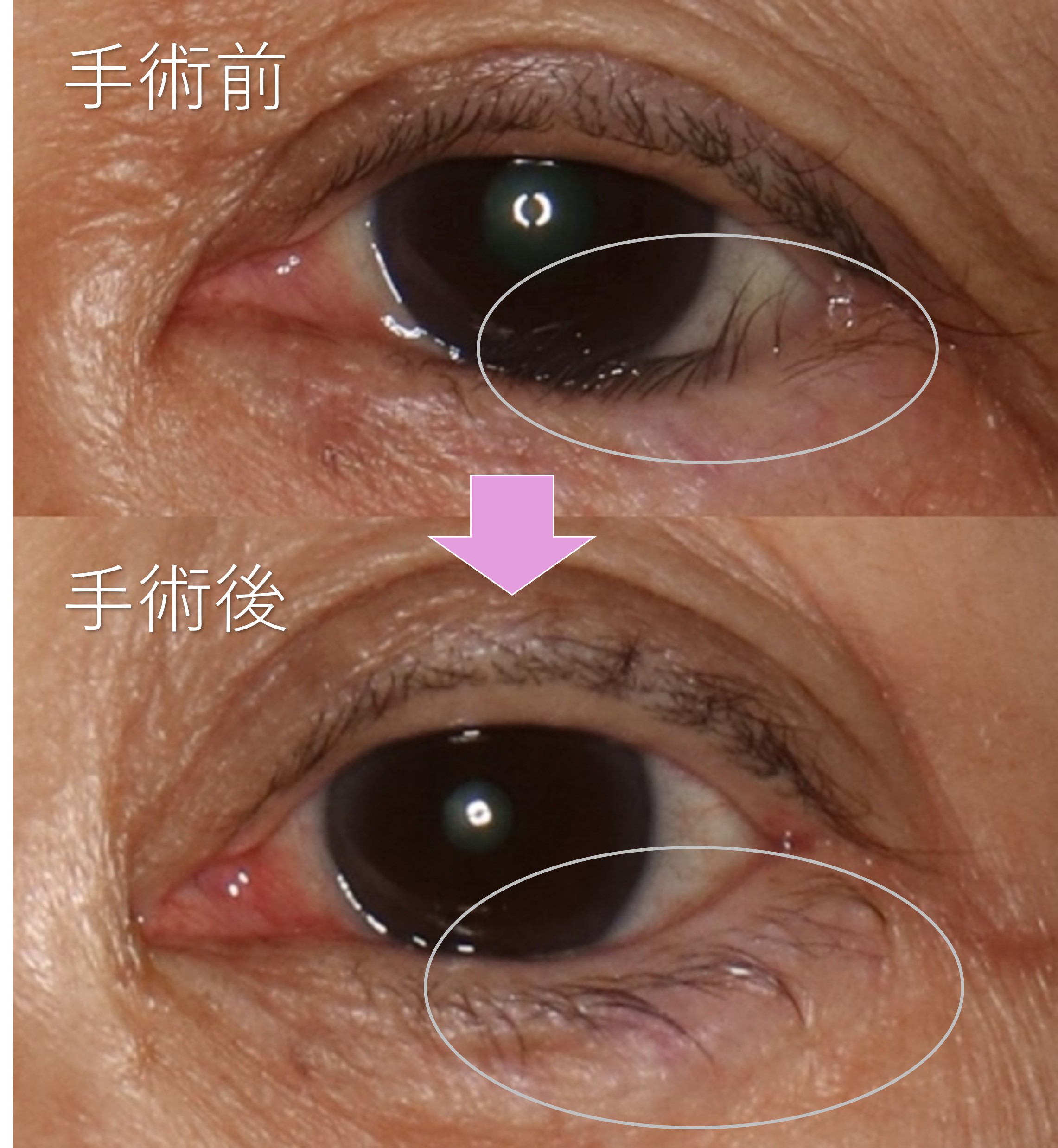酒井Dr.後天性内反症例写真
