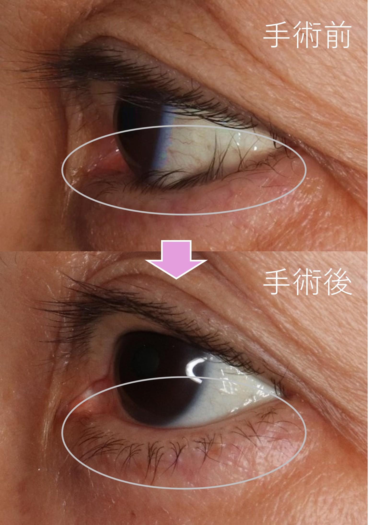 酒井Dr.後天性内反症例写真
