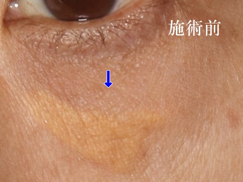 眼瞼黄色腫の「手術症例術前