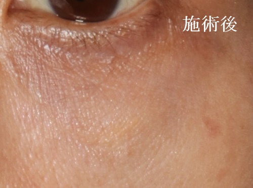 眼瞼黄色腫の「手術症例術後