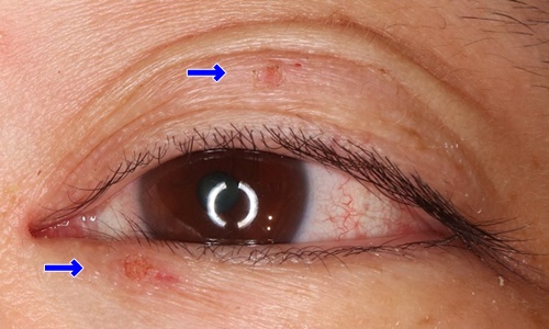 イボ炭酸ガスレーザー症例術後