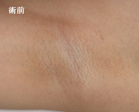 ワキガ・腋臭症手術（皮弁法）症例写真1