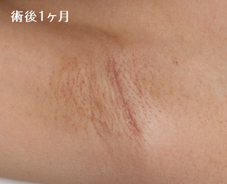 ワキガ・腋臭症手術（皮弁法）症例写真1