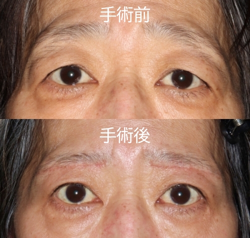 酒井Dr.眼瞼下垂症例写真4