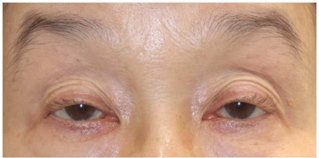 酒井Dr.眼瞼下垂症例写真1
