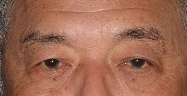 酒井Dr.眼瞼下垂症例写真2