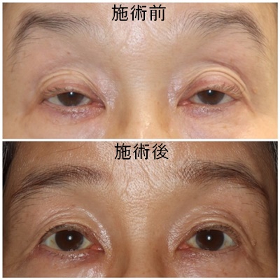 酒井Dr.眼瞼下垂症例写真3
