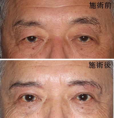 酒井Dr.眼瞼下垂症例写真4