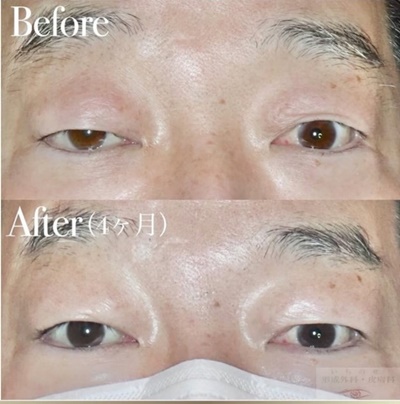 酒井Dr.眼瞼下垂症例写真5