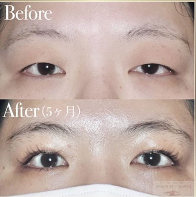 酒井Dr.眼瞼下垂症例写真6