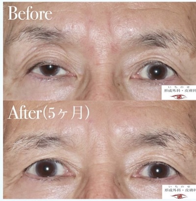 酒井Dr.眼瞼下垂症例写真7