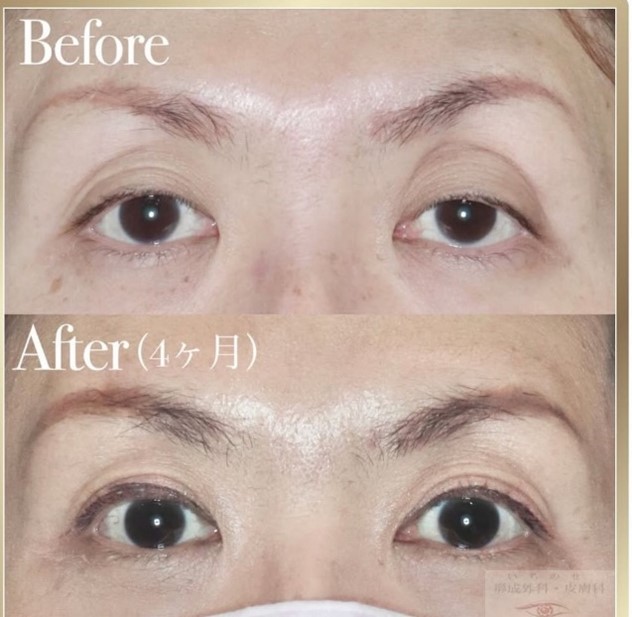 酒井Dr.眼瞼下垂症例写真8